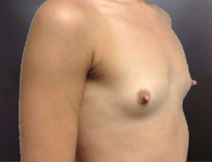 Angle view, breast augmentation before: 34A