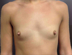 Front view, before breast augmentation: 34A