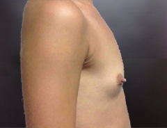 Side View, Breast Augmenation, Before: 34A