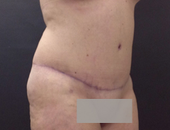 Angle view, full tummy tuck, after