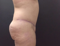 Side view, full tummy tuck, after