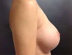 Side view, breast augmentation, after