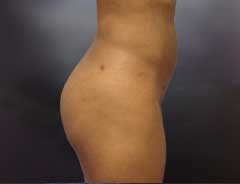After Liposuction side