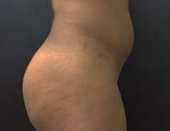 Before Liposuction side