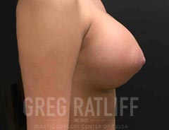 Breast Aug - Side View - After Surgery