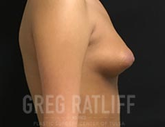 Breast Aug - Side View - Before Surgery