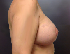 Side View, Breast Aug & Lift, Before: Fuller Highe