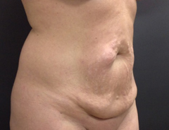 Angle view, full tummy tuck, before