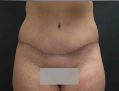 front view, full tummy tuck, after