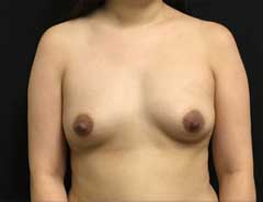 Front view, breast augmentation, before