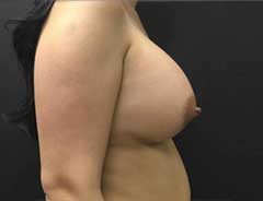 Side view, breast augmentation, after