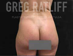 After Liposuction Back