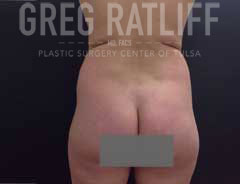 Before Liposuction Back