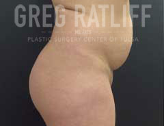Before Liposuction side