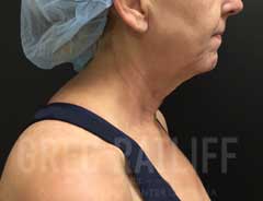 FaceTite -- Before