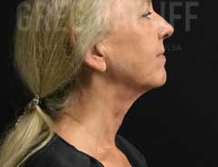 FaceTite -- After