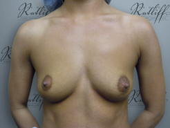 Front view, before breast augmentation: 34B