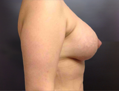 Side View, Breast Aug & Lift, After: 38D Full