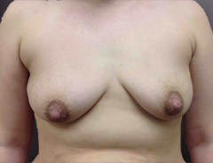 Front view, before breast augmentation & lift: 36B