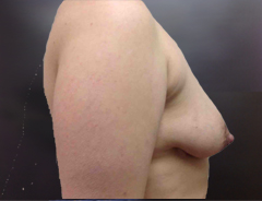 Side View, Breast Augmenation & Lift, Before: 36B