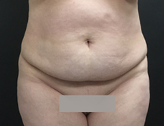 Front View, extended tummy tuck, before