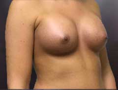 Angle view, breast augmentation, after