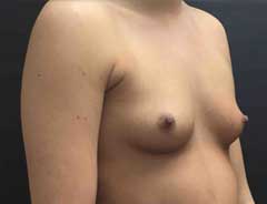 Angle view, breast augmentation, before