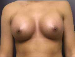 Front View, Breast Augmenation, after
