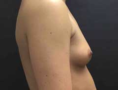 Side view, breast augmentation, before