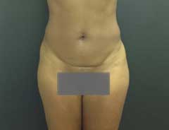 Before Mini Tummy Tuck Front