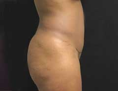 After Mini Tummy Tuck Side