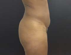 Before Mini Tummy Tuck Side