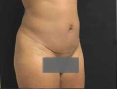 After Mini Tummy Tuck Tween