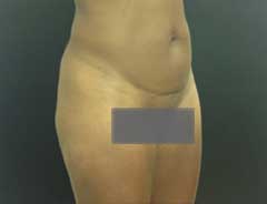 Before Mini Tummy Tuck Tween