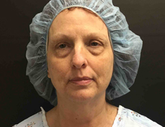 facetite -- before
