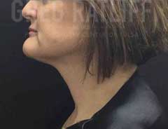 NeckTite -- After