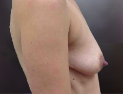 Side View, Breast Augmenation & Lift, Before: 36A