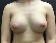 Front view, breast augmentation, after