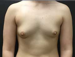 Front view, breast augmentation, before