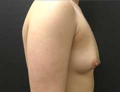 Side view, breast augmentation, before