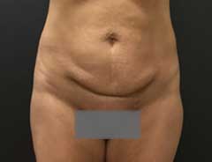Before Mini Tummy Tuck Front