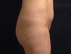After Mini Tummy Tuck Side