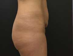 Before Mini Tummy Tuck Side