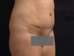 After Mini Tummy Tuck Tween