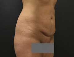 Before Mini Tummy Tuck Tween