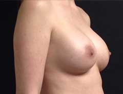 Angle view, breast augmentation, after
