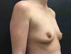 Angle view, breast augmentation, before