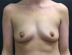 Front View, Breast Augmenation, before