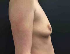 Side view, breast augmentation, before