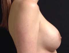 Side view, breast augmentation, after